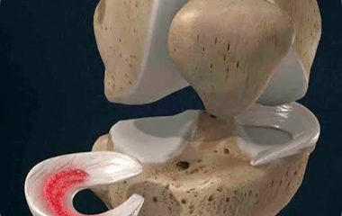 Transplante de Tecido Musculoesquelético: nova esperança para a mobilidade, disponível no Monte Sinai